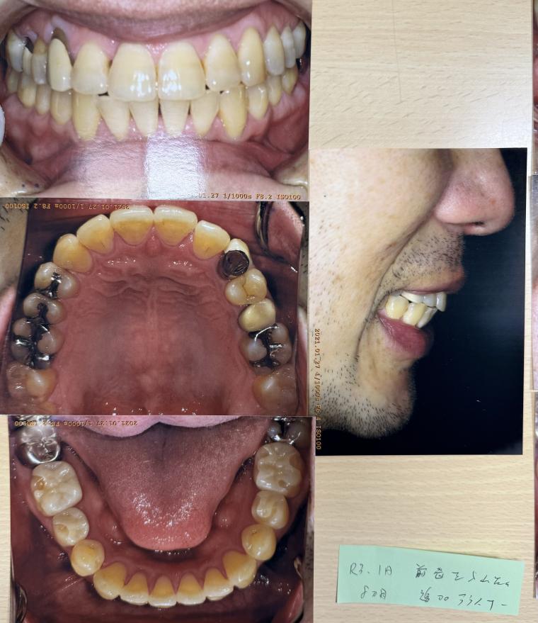 審美歯科とインビザライン を併用して歯並びを綺麗に微調整した40代男性。