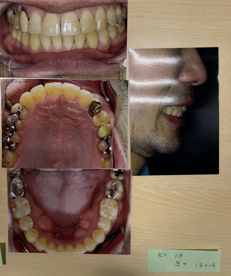 審美歯科とインビザライン を併用して歯並びを綺麗に微調整した40代男性。